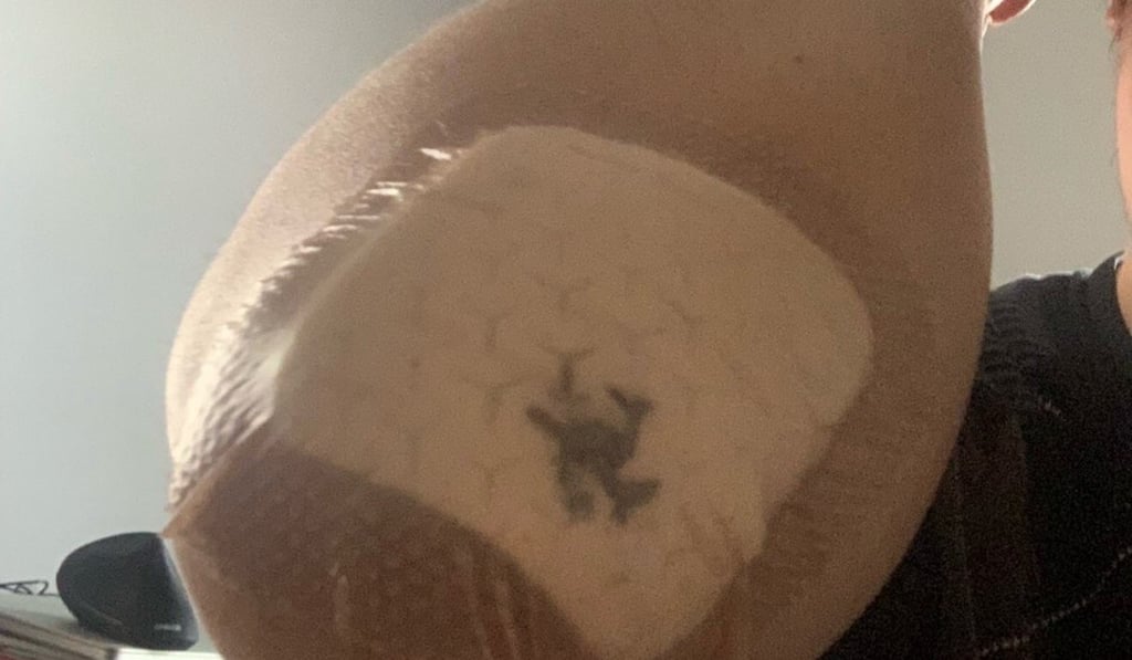 In addition to facial injuries, lecturer Peng Wang was also left with bruises on his arm after the attack. Photo: Handout