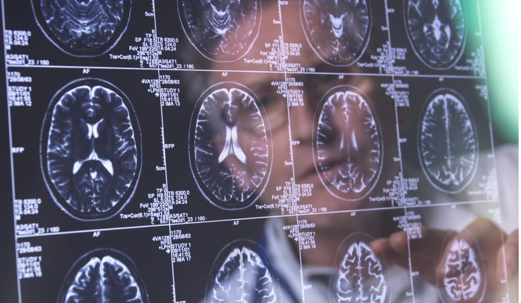 Brain imaging is commonly used to identify the disease. Photo: Science Photo Library via AFP