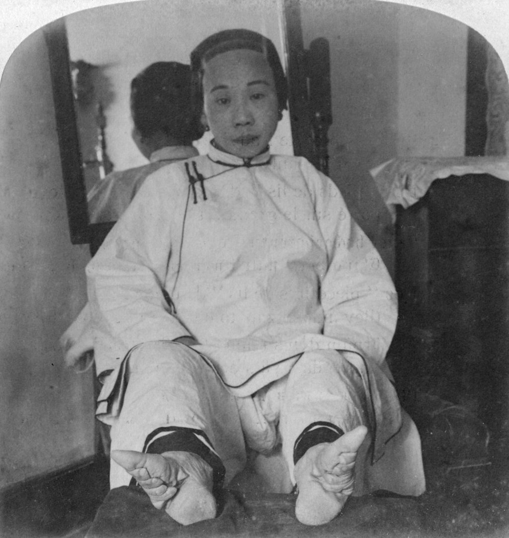 A picture of a woman showing the deformities of her feet caused by binding. Photo: Getty Images