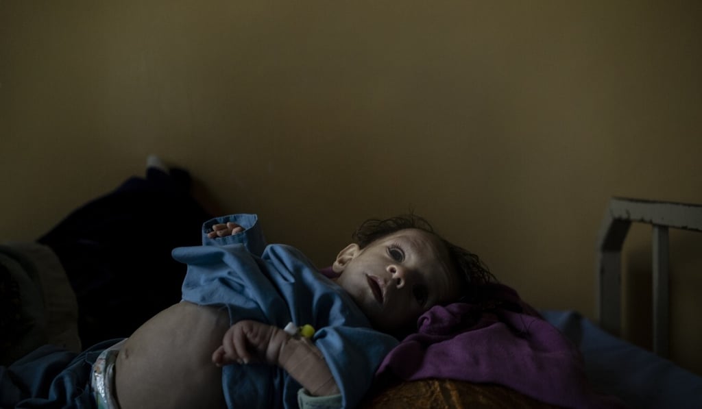 A one-year-old boy suffering from malnutrition lies on a hospital bed in Afghanistan. Photo: AP