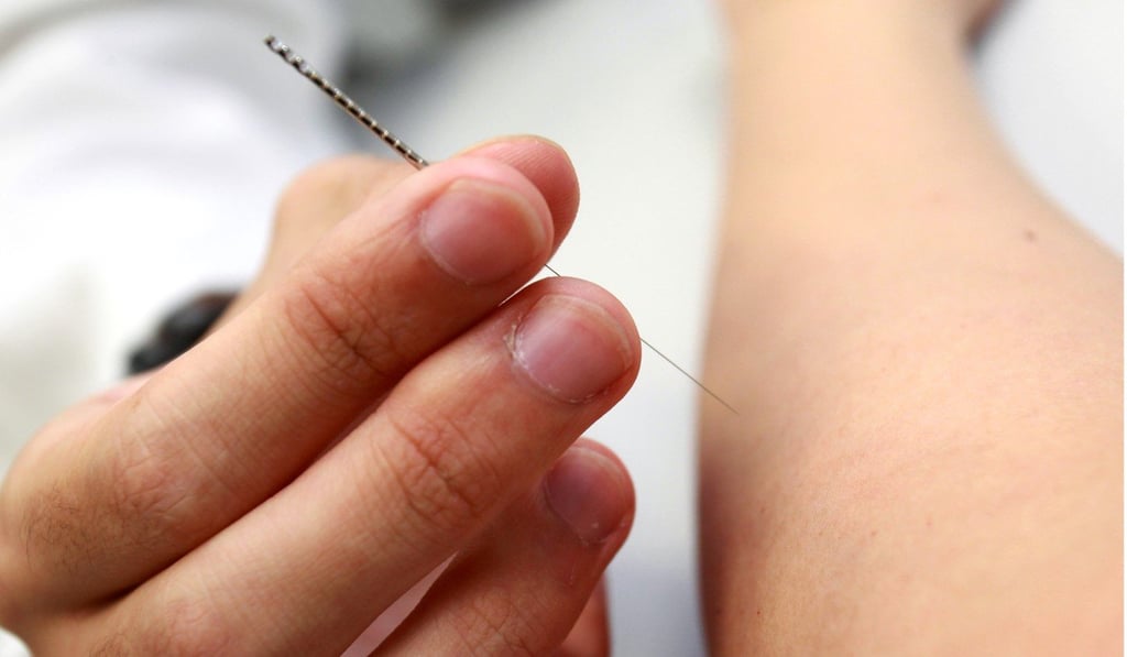 Acupuncture has thrived for thousands of years because of the power of belief. It is so powerful that its placebo effect can trigger the release of endorphins that really do work as painkillers, although not in the way acupuncturists with their explanations about qi and body meridians would have us believe. Photo: May Tse