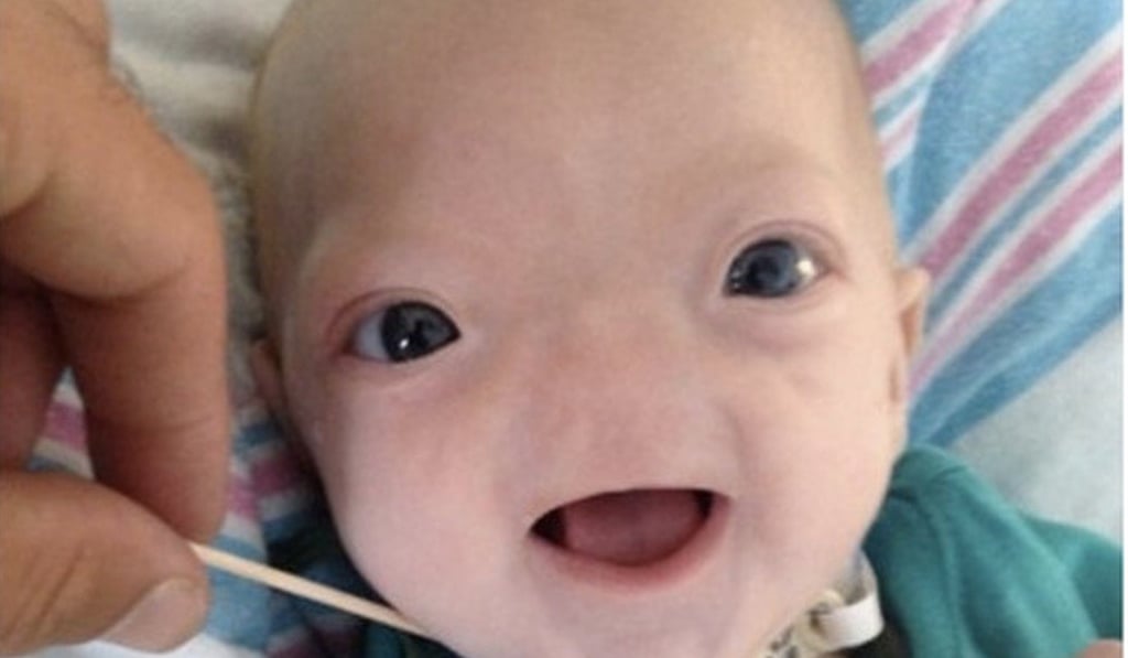 Eli Thompson was born in 2015 without a nose as a result of congenital arhinia. Photo: Facebook