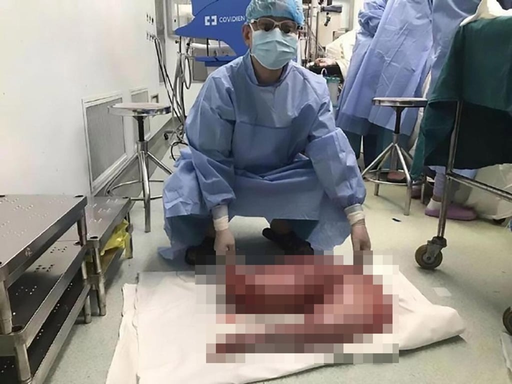 Surgeons removed a part of the man’s colon, containing 13kg of faeces. Photo: Handout