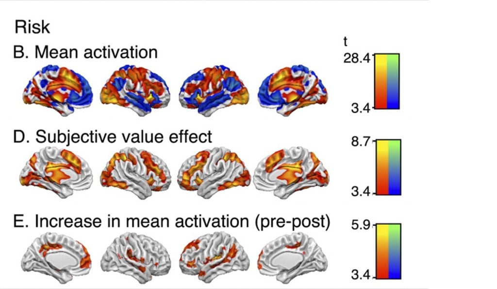 Illustrations of brain activity during decision-making recorded during the study. Photo: Courtesy of Penn Medicine
