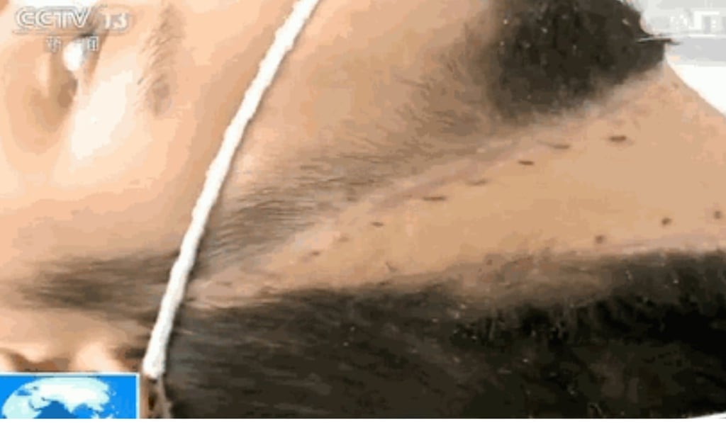 The unnamed woman has undergone four operations to remove a blood clot from her brain. Photo: Handout