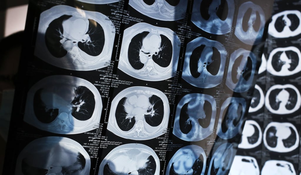 A file picture of a doctor in Hebei province examining CT scans of lung cancer patients. Photo: Associated Press
