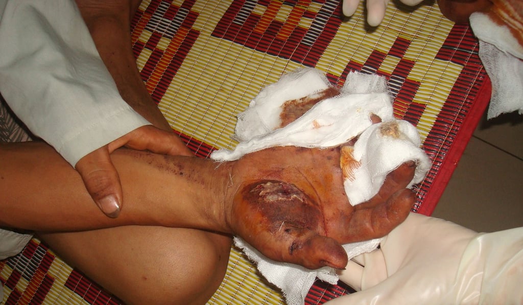 Nguyen Duc Nha is treated at a hospital in Dong Ha city, Quang Tri, Vietnam, after a piece of ordnance, left over from the Vietnam war, exploded while he searched for scrap metal. Photo: AFP