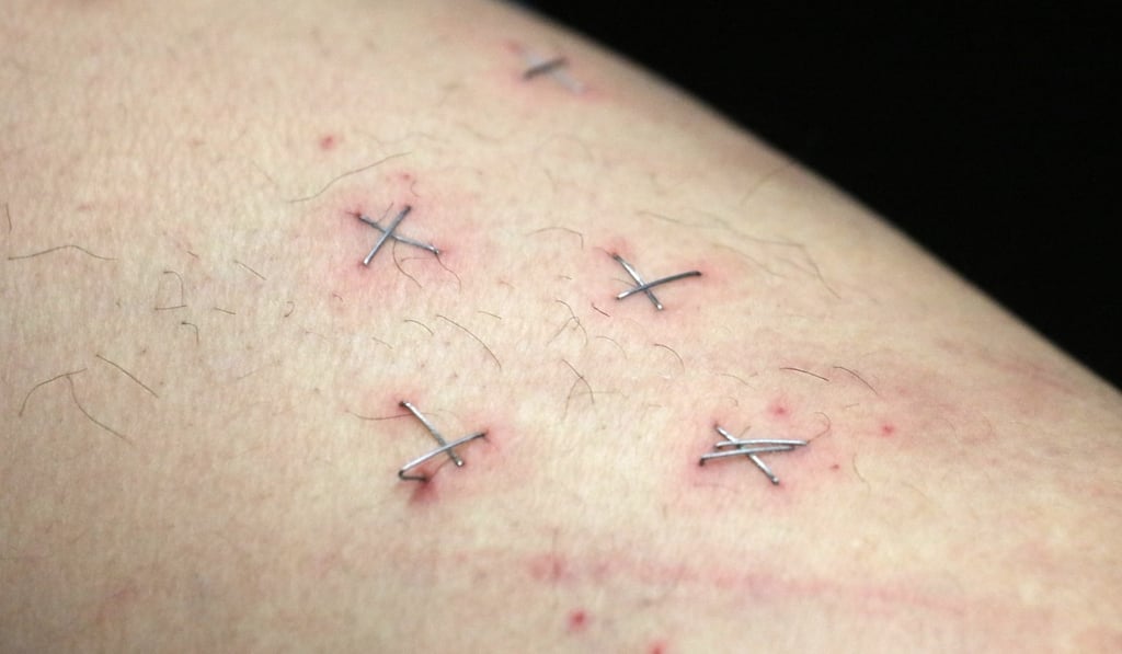 Howard Lam shows staples in his legs. Photo: Felix Wong