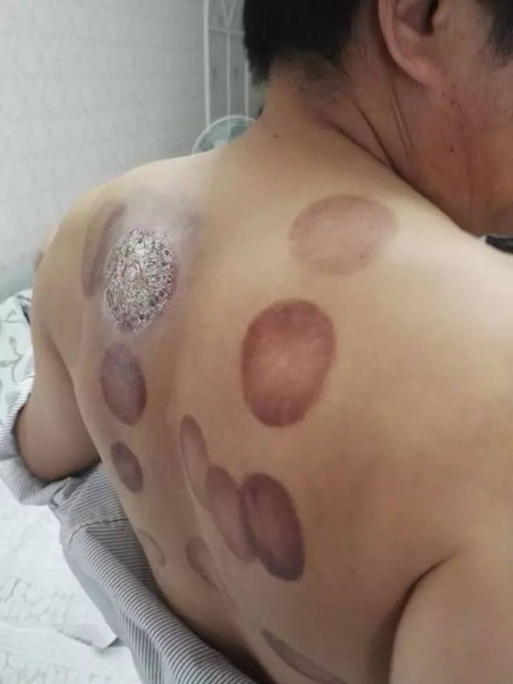 Hu had been suffering from back pain and decided to treat it himself with his home cupping therapy kit. Photo: Handout