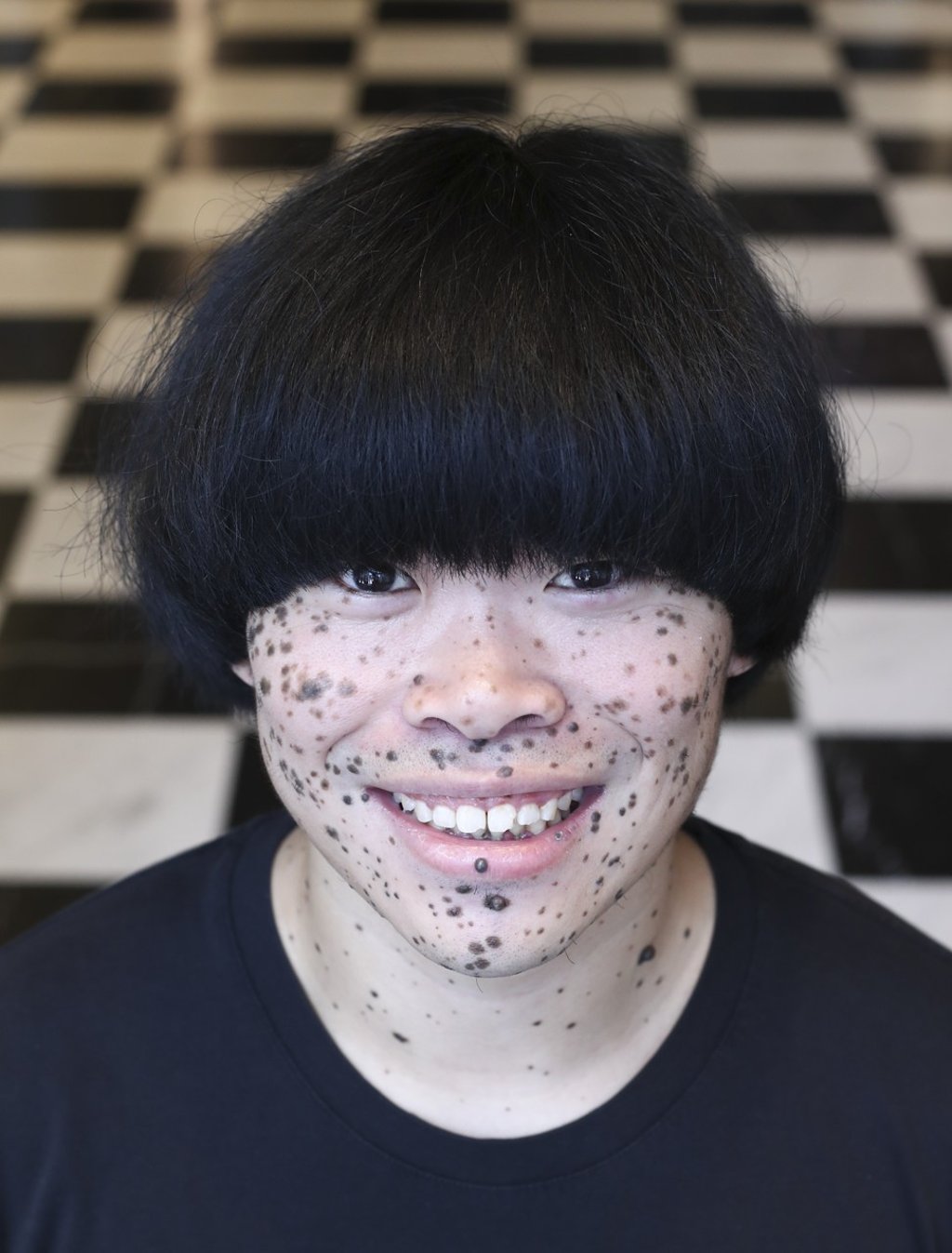 William Chan has a rare and lethal form of skin cancer. Photo: Nora Tam