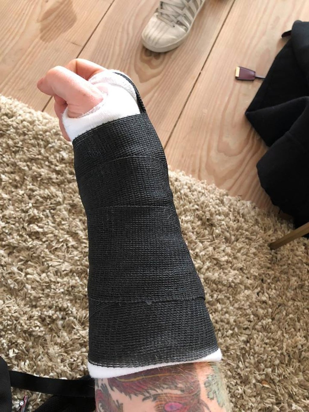 Ed Sheeran’s broken wrist.