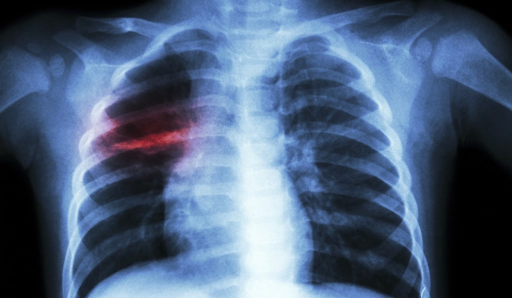 A chest X-ray of a child with pulmonary tuberculosis. Photo: Shutterstock