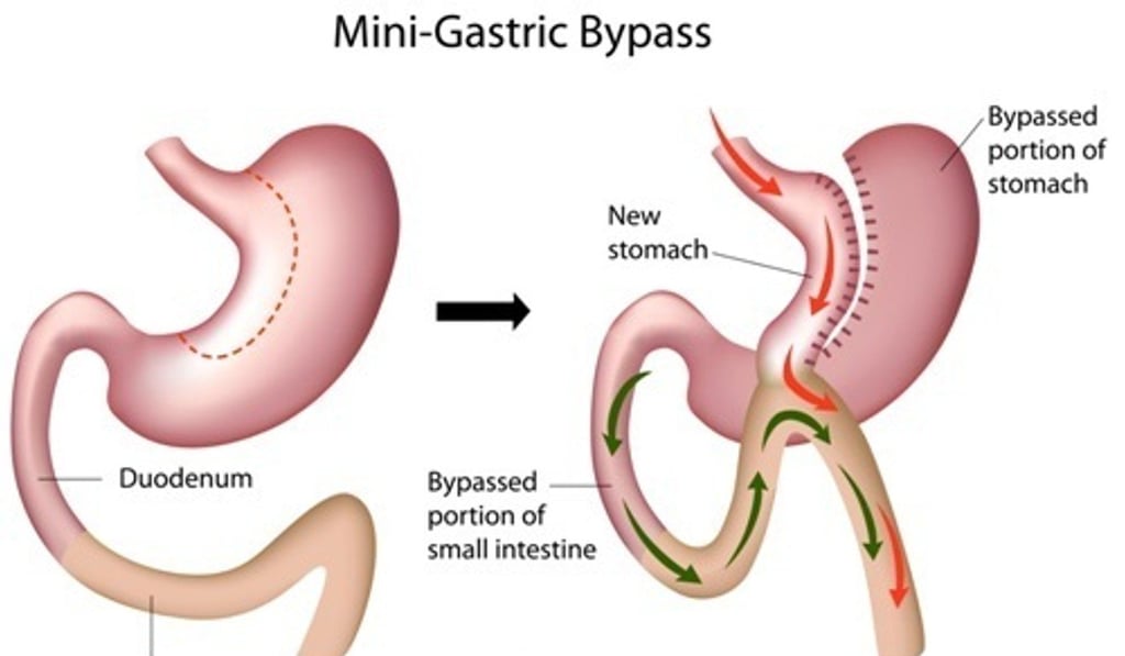 A diagram of a mini gastric bypass weight-loss surgery. Photo: Shutterstock