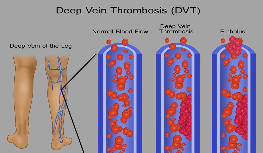 A normal vein (left) and ones with deep vein thrombosis (DVT) and embolus. An embolus is any detached, travelling intravascular mass carried by circulation, which is capable of clogging arterial capillary beds. Illustration: Alamy