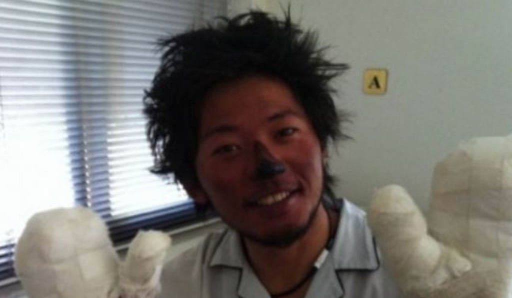 In 2012, Nobukazu Kuriki had to have his fingertips amputated after he spent two days in a snow hole. File photo: Twitter