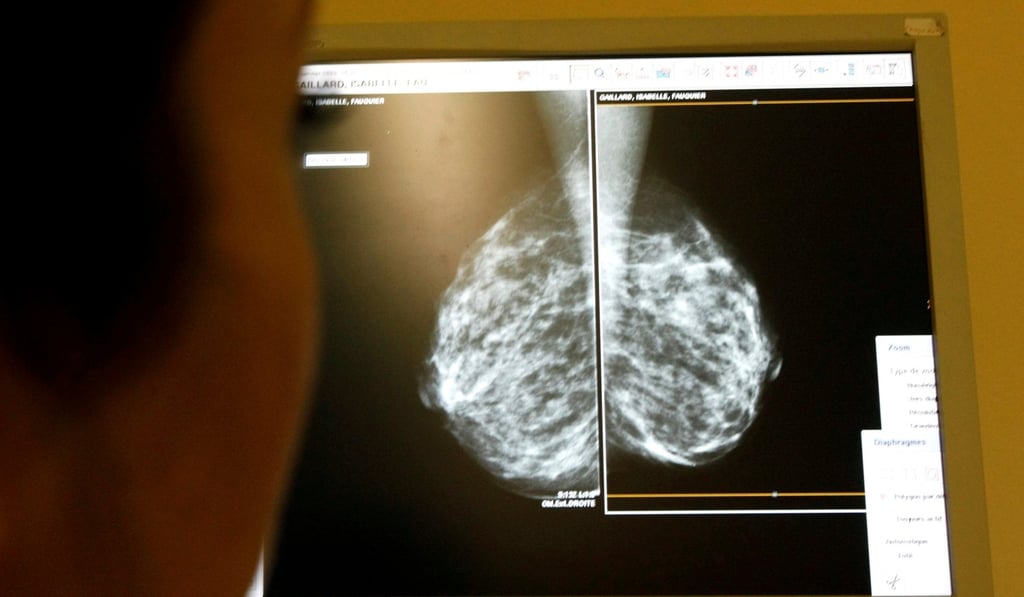 A doctor examines mammograms, as part of a regular breast cancer prevention check-up at a clinic in Nice, southeastern France. Photo: Agence France-Presse
