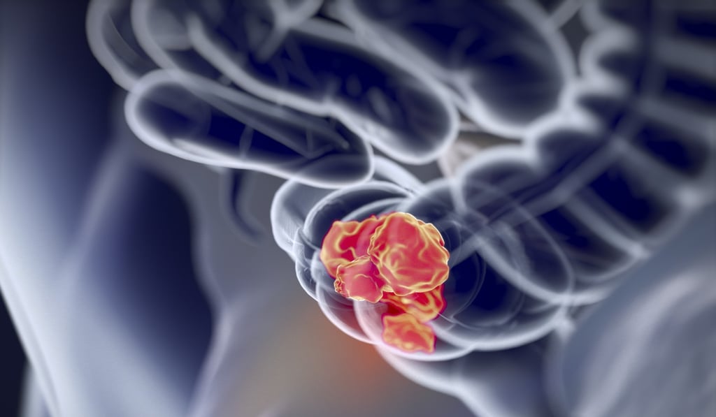 An illustration of colorectal cancer, which is on the rise among younger Hongkongers. Photo: Shutterstock