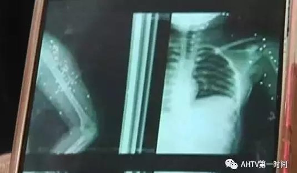 X-rays showing the pellets inside the girl’s body. Photo: Baidu X-rays showing the pellets inside the girl’s body. Photo: Baidu