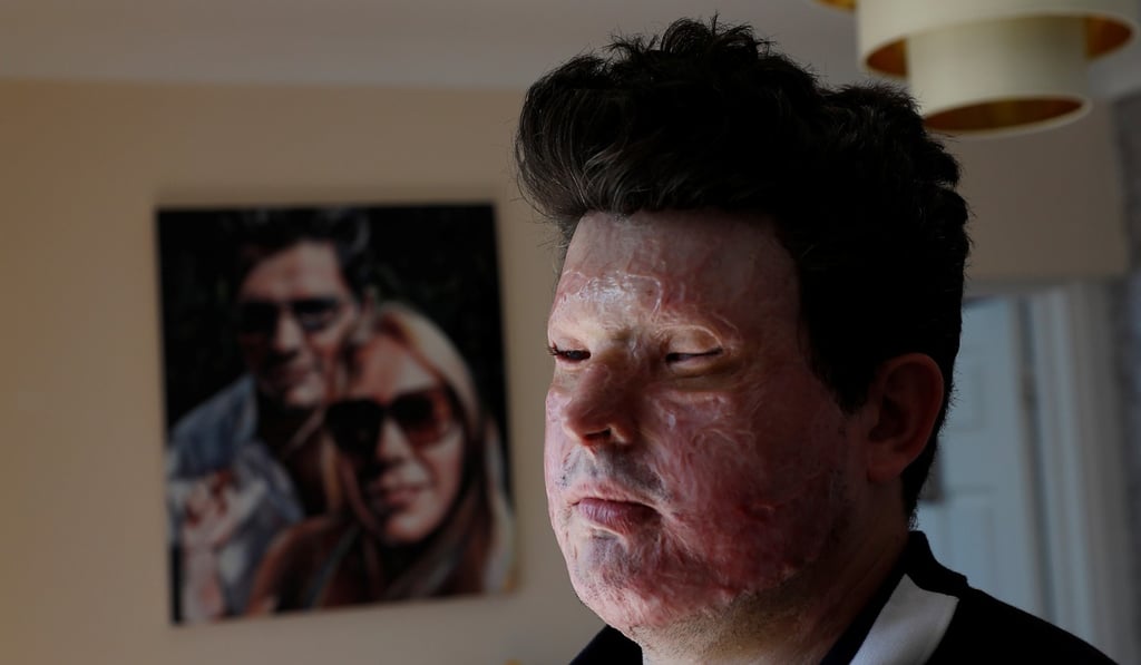 Acid attack victim Andreas Christopheros at his home in Truro, southwest England, in July 2017. Photo: Reuters