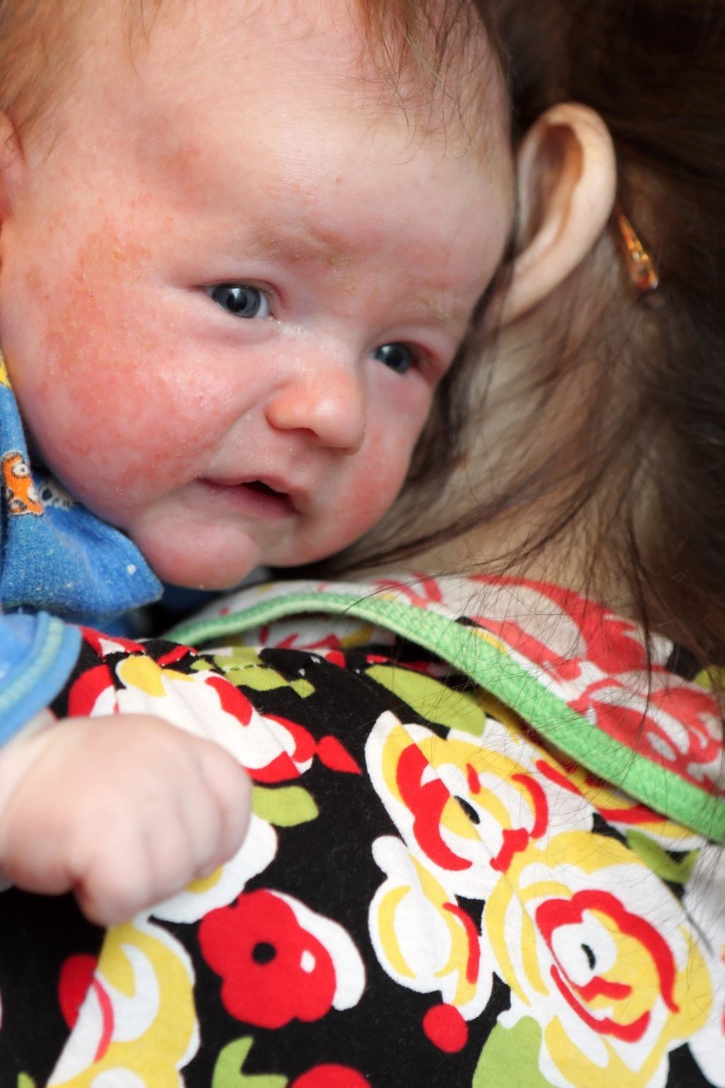 A baby suffering from eczema. Photo: Handout