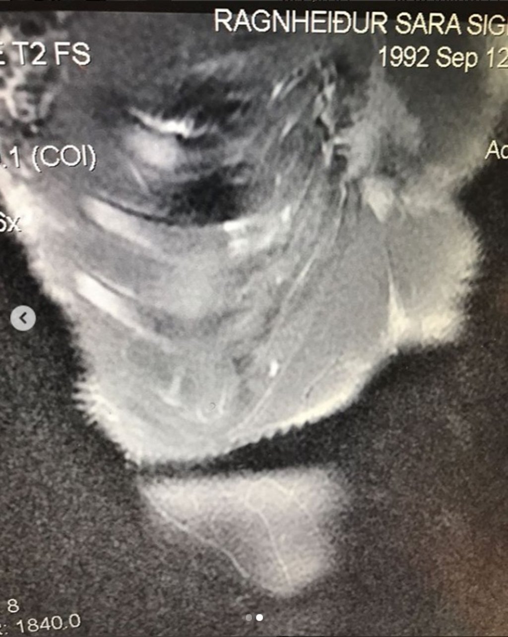 An MRI of Sara Sidmundsdottir's broken rib. Photo: Instagram/@sarasigmunds