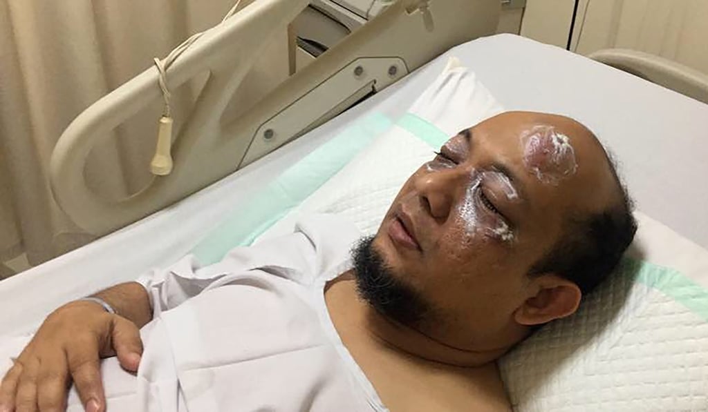 Novel Baswedan, a prominent Indonesian corruption investigator, is treated at a hospital in Jakarta after motorbike-riding assailants threw acid in his face. Photo: AFP Novel Baswedan, a prominent Indonesian corruption investigator, is treated at a hospital in Jakarta after motorbike-riding assailants threw acid in his face. Photo: AFP