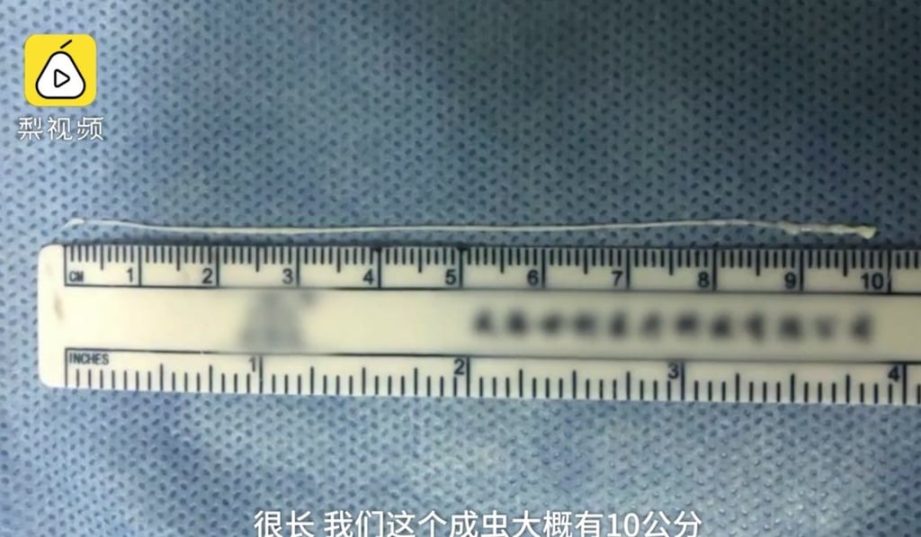 The 10cm live worm removed from the brain of a man in Nanchang, Jiangxi province. Photo: Pear Video