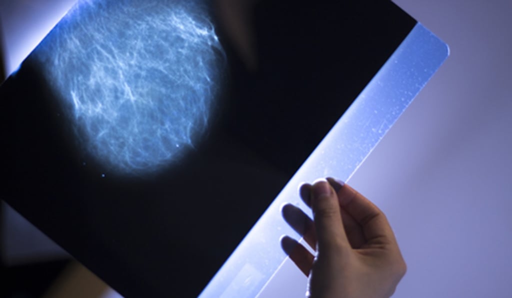 Experts remain divided on the need for universal breast cancer screening. Photo: TNS