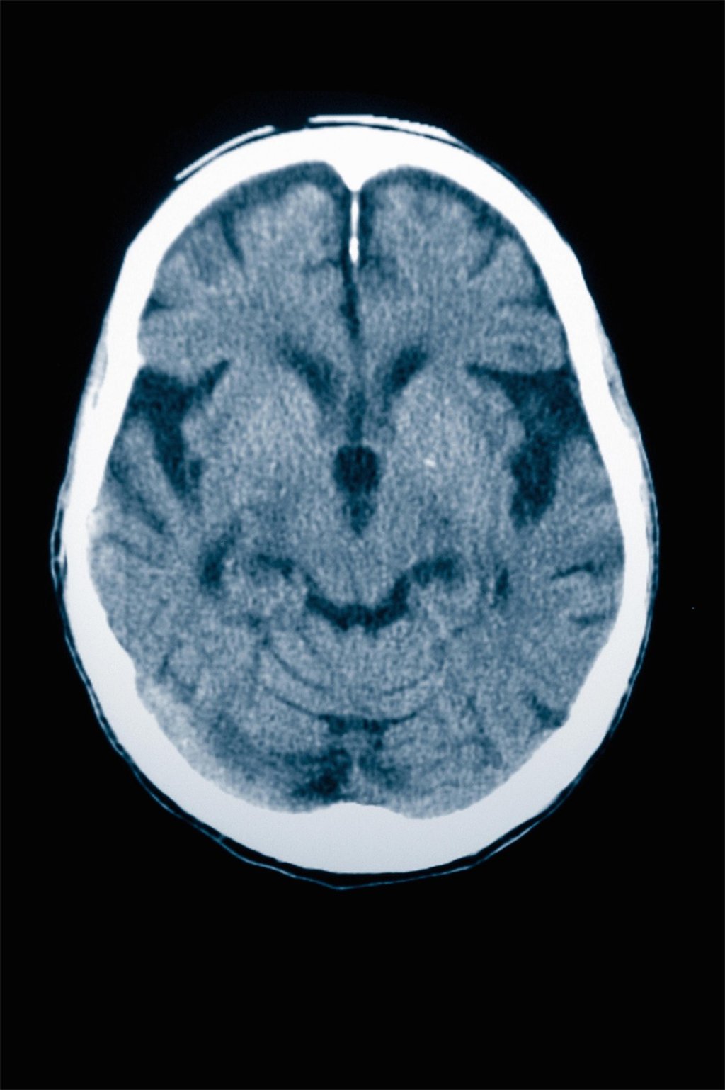 A CT scan of an 84-year-old male with Alzheimer's disease shows brain atrophy. Photo: Alamy