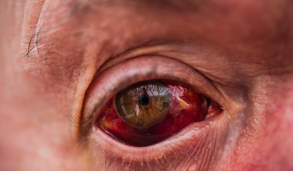 If your eyes are bloodshot or red, avoid using lenses. Photo: Alamy