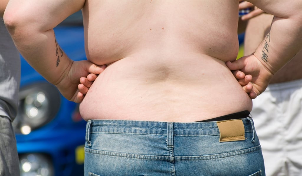 Obesity is often the cause of more serious health problems. Photo: Alamy