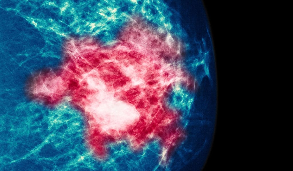 A mammogram indicating breast cancer. Photo: Alamy