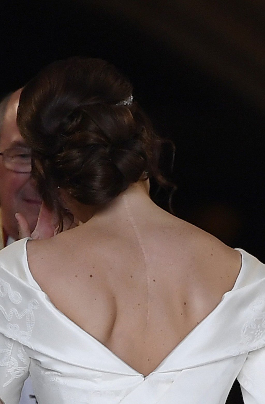 Britain’s Princess Eugenie’s Peter Pilotto wedding gown shows a scar that extended from her neck to the middle of her shoulder blades. Photo: AP