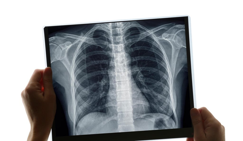 A patient at Prince of Wales Hospital went undiagnosed for almost two years after doctors failed to spot an abnormality on an X-ray. Photo: ALAMY
