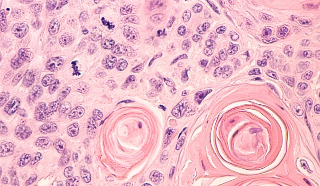 A photomicrograph of a biopsy sample showing pulmonary squamous cell carcinoma, a lung cancer associated with smoking. Photo: Shutterstock