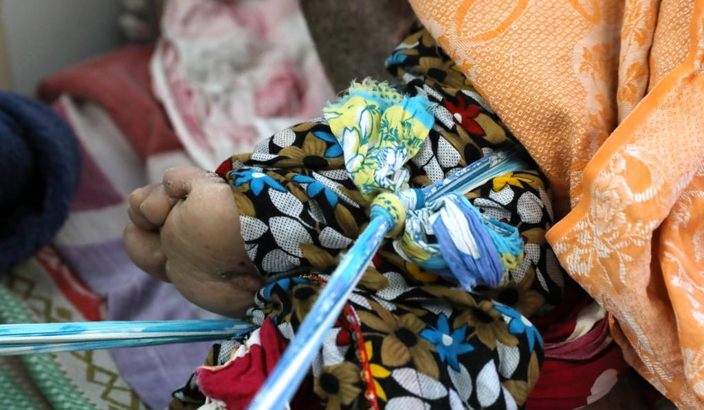 Yousaf Akbar's legs are tied to the bedside because of contracture. Photo: K.Y. Cheng