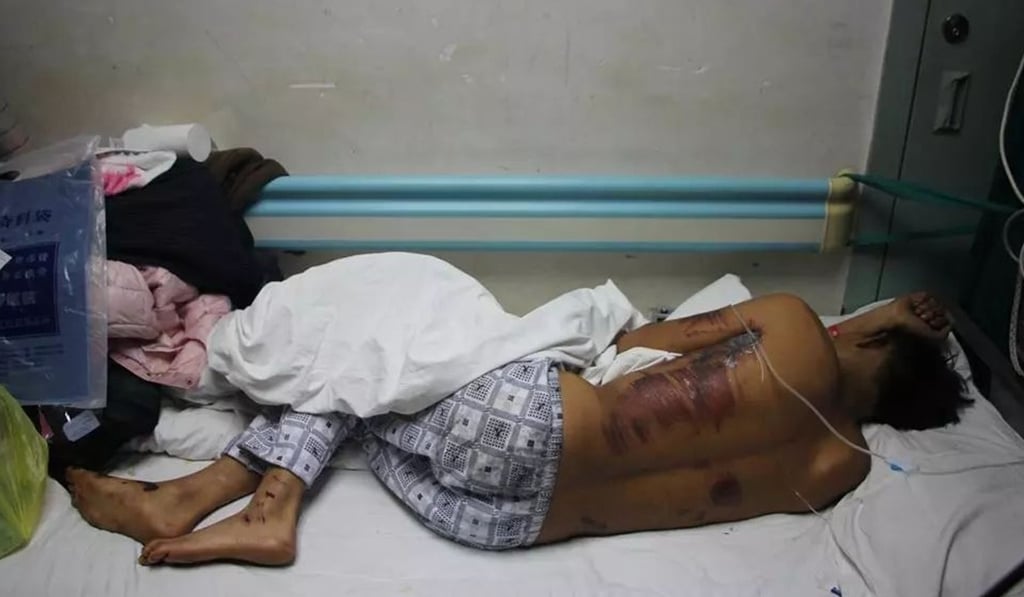 Ai suffered a fractured skull among other injuries. Photo: Sohu.com