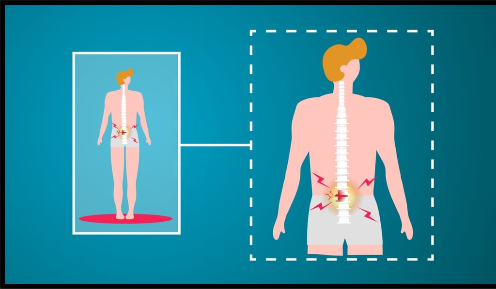 Although the prolapsed intervertebral disc (PID) is often called “a slipped disc”, the term is a misnomer, as a disc is gel-like tissues in the joint and it does not slip. But in the case of PID, excessive pressures cause part of a disc to protrude and come in contact with the nearby nerves. Graphic: SCMP
