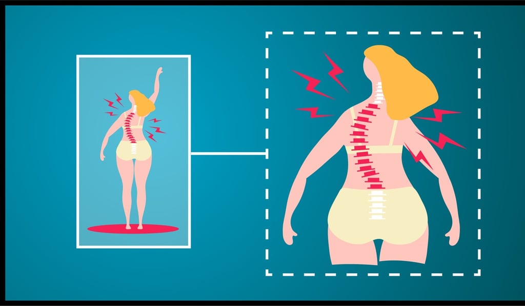 When the X-ray shows a patient’s spine curving to the side or to the back at more than 10 degrees, it will be considered a case of scoliosis. Graphic: SCMP