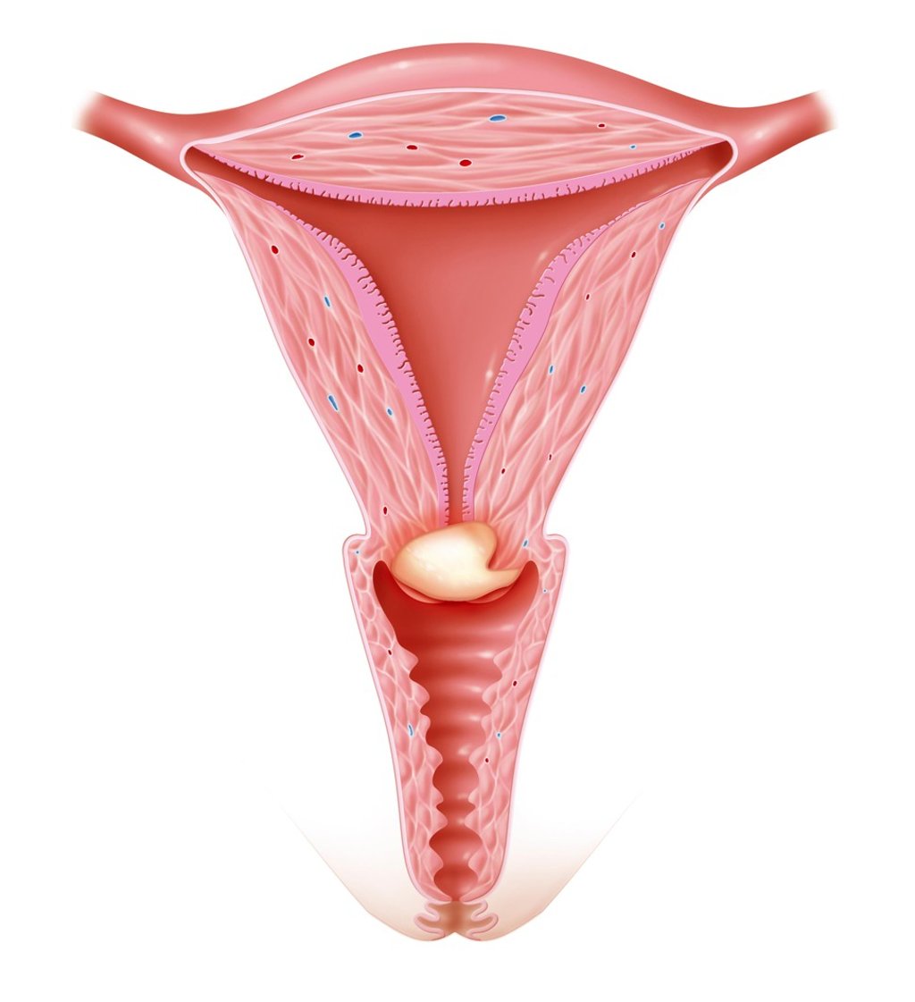 An illustration of cervical cancer. Photo: Alamy