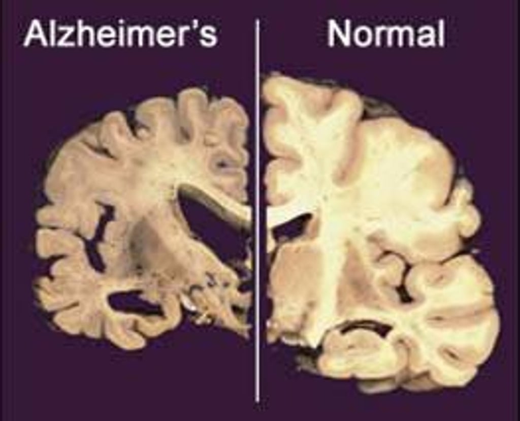 This undated file image provided by Merck & Co, shows a cross section of a normal brain, right, and one of a brain damaged by advanced Alzheimer's disease. Photo: AP