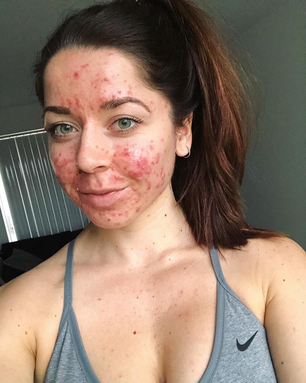 Keel posts photos on Instagram to highlight how acne affects people.