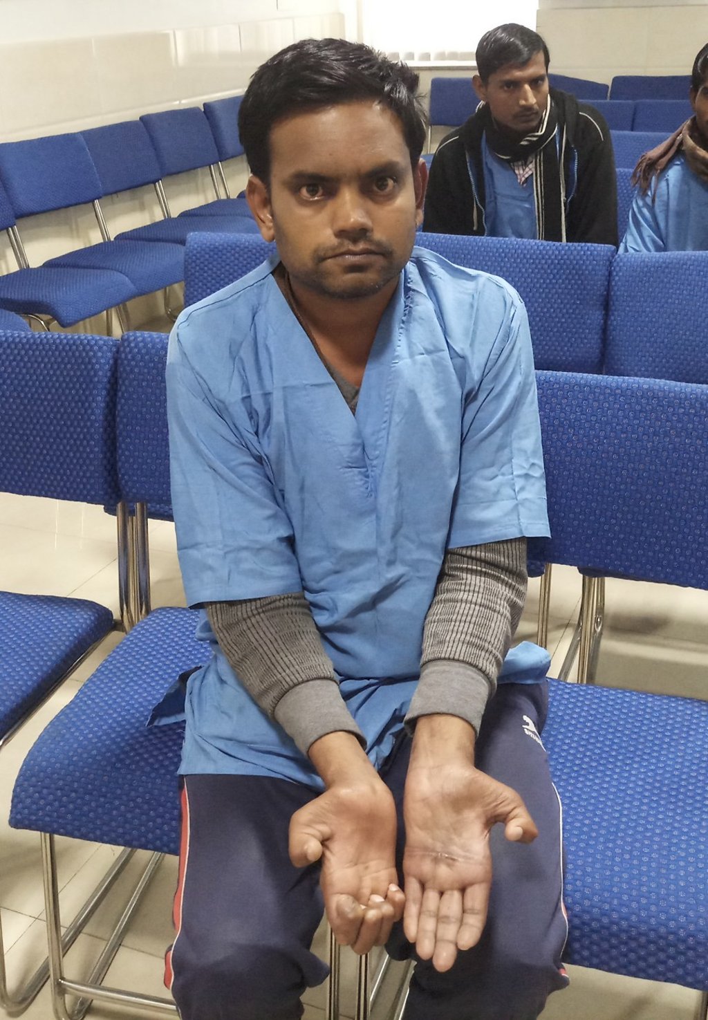Tribuwan shows his leprosy-damaged hands. Unlike many people with the disease, his wife has stood by with him.