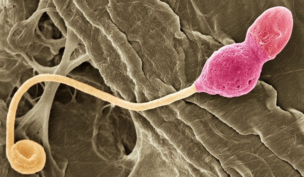 A coloured scanning electron micrograph of a sperm cell with a deformed tail. Such a cell would stand little chance of making it through the obstacles of the female reproductive tract. Photo: Shutterstock