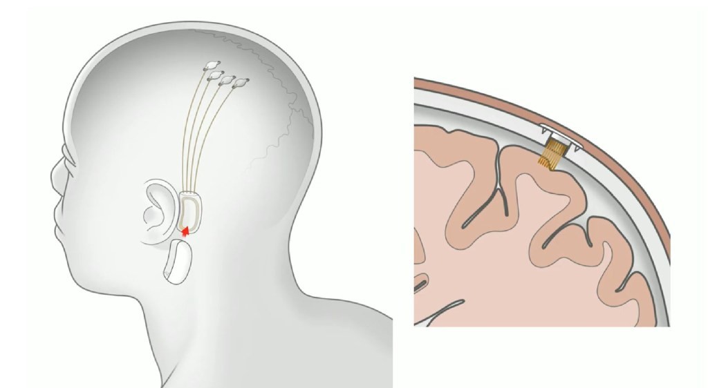 The threads are thinner than a human hair. (Picture: Neuralink)