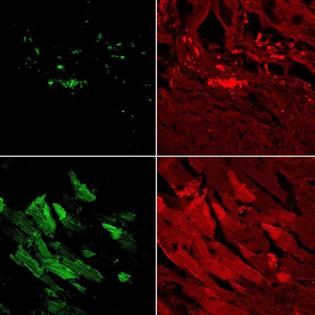 Representative immunostaining images showing hiPSC-CM-GFP (green) and MYH6/7 gene (red) when hiPSC-CMs were injected in MI hearts. Representative immunostaining images showing hiPSC-CM-GFP (green) and MYH6/7 gene (red) when hiPSC-CMs were injected in MI hearts.