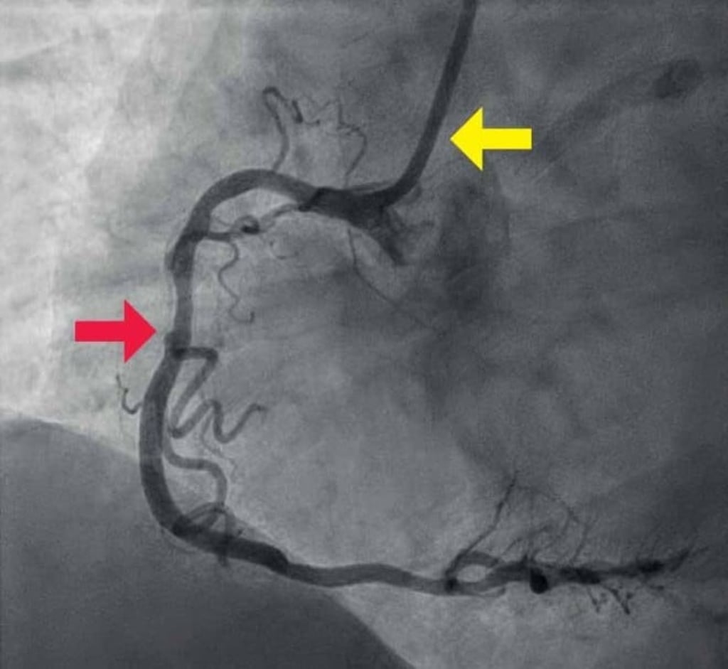 Yellow arrow: Dye is injected through a catheter as thin as a ball-point pen refill. Red arrow: Narrowing of the artery due to cholesterol accumulation. Imaging from inside the artery with OCT in the next few images.