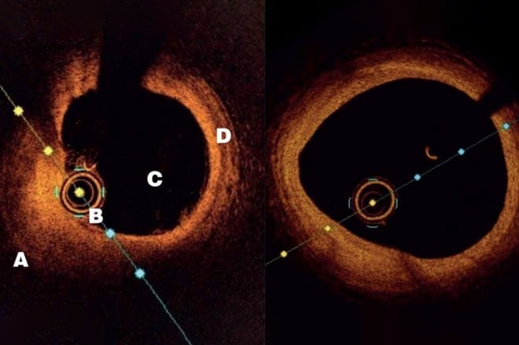 Cross-section of heart artery at the same location in 2018 (left) and 2020 (right), showing marked reduction in the amount of cholesterol accumulated in the artery wall. A: Cholesterol pool in heart artery wall causing narrowing and blockage of bloodflow. B: OCT imaging catheter is just a little thicker than a hair. C: The path where blood flows inside the artery. D: A relatively normal part of the artery with three distinct layers. (Image provided by Dr. Adrian Cheong)