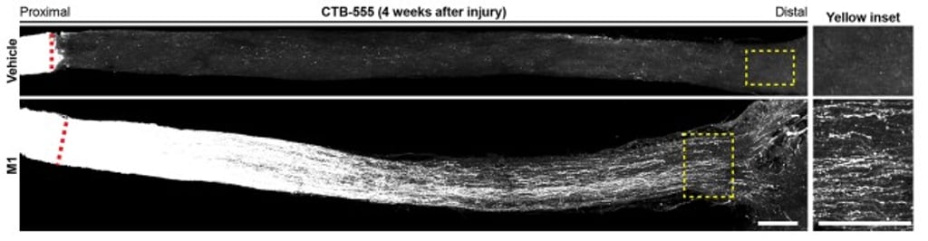 M1 treatment sustains long-distance axon regeneration along the optic nerve as shown in the lower part of the image.
