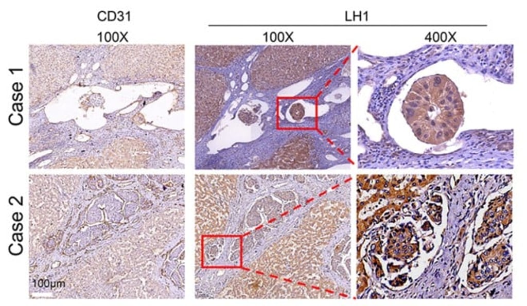 LH1 was strongly expressed in HCC tumour embolus. (Credit: © Yang, Z. et al. https://molecular-cancer-biomedcentral-com.libproxy1.nus.edu.sg/articles/10.1186/s12943-023-01727-9) LH1 was strongly expressed in HCC tumour embolus. (Credit: © Yang, Z. et al. https://molecular-cancer-biomedcentral-com.libproxy1.nus.edu.sg/articles/10.1186/s12943-023-01727-9)